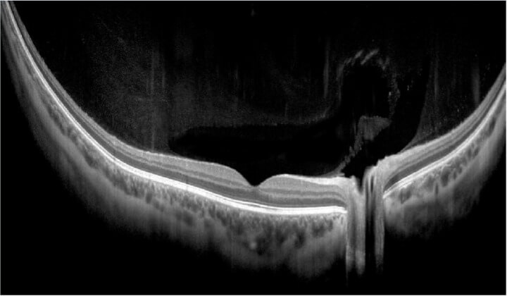 Ultra Widefield - 21mm on Retina